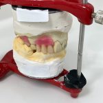 Acrylic partial denture Construction