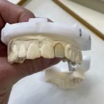 Zirconia Crown