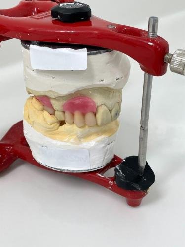 Acrylic-partial-denture-Construction